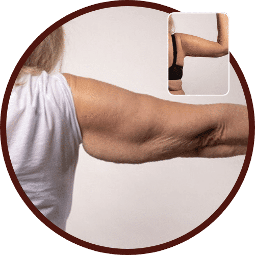 Arm Lift (Brachioplasty) in Turkey – All Included £2,485