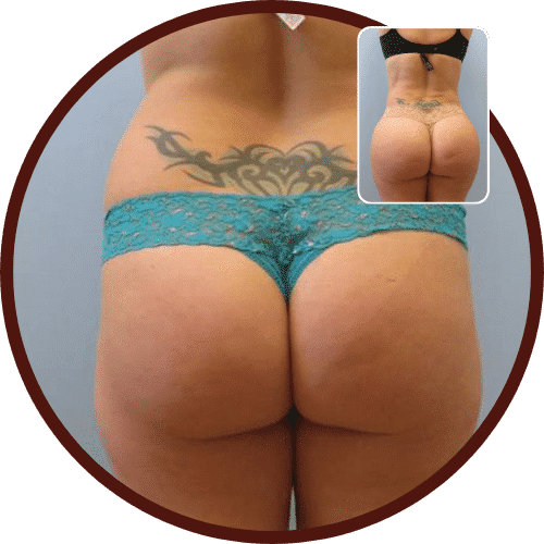 Brazilian Butt Lift (BBL) in Turkey – All Included £3,750