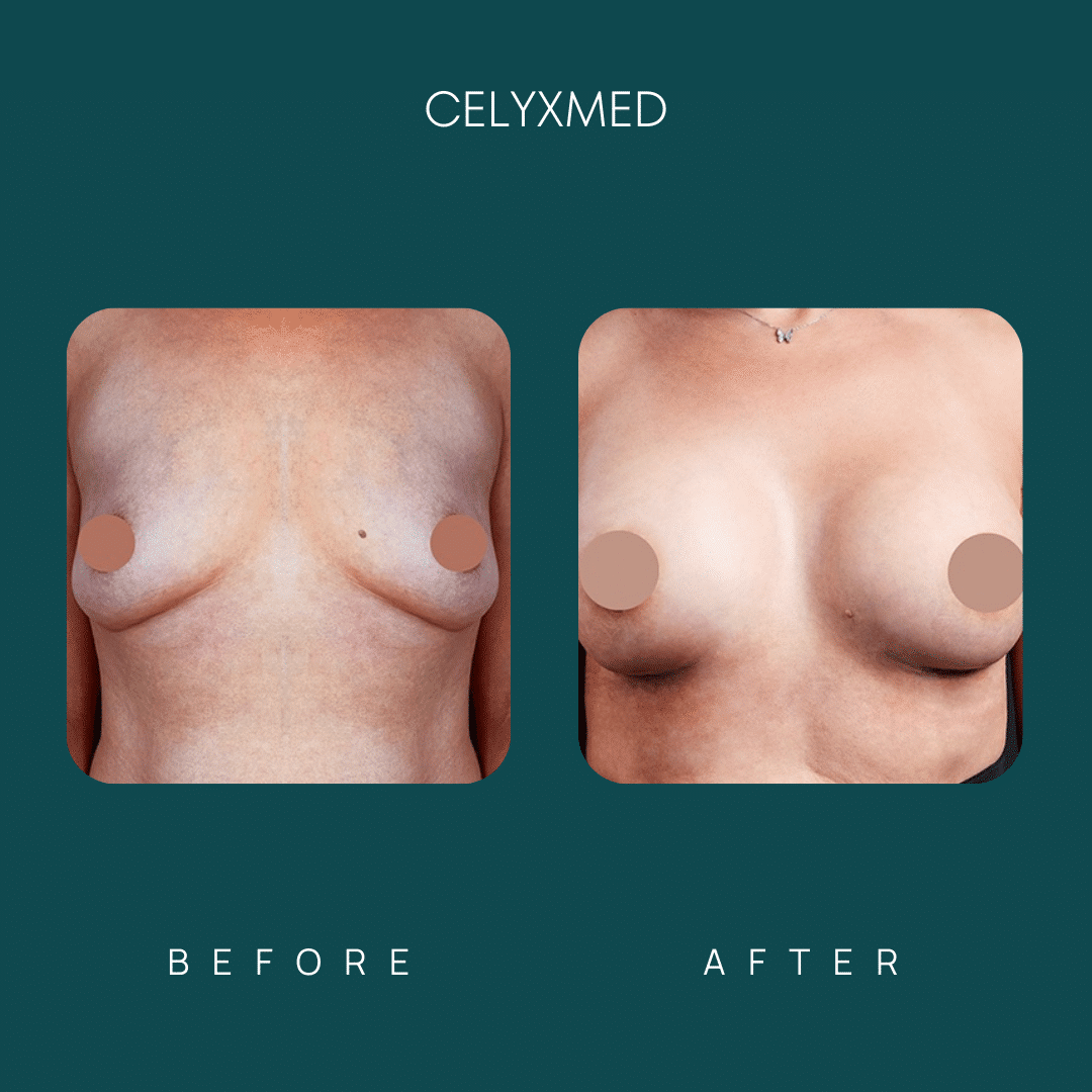 breast-augmentation-in-turkey-before-and-after-1