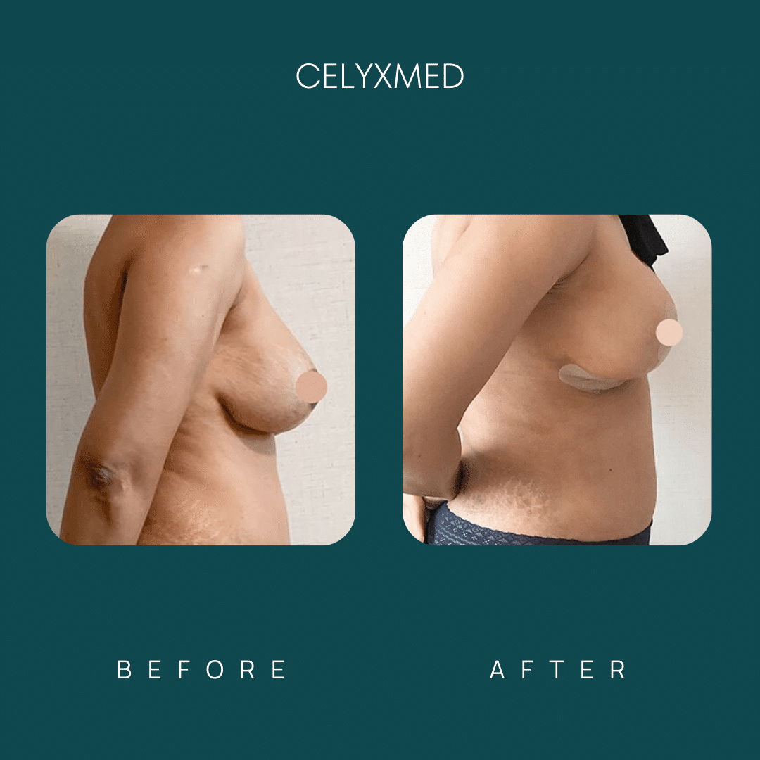 breast-augmentation-in-turkey-before-and-after-2