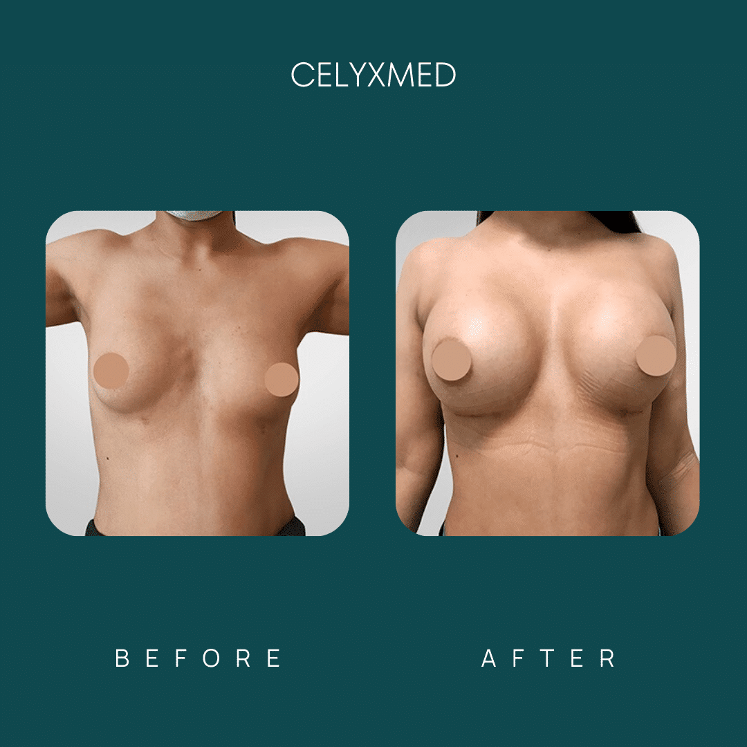 breast-augmentation-in-turkey-before-and-after-4