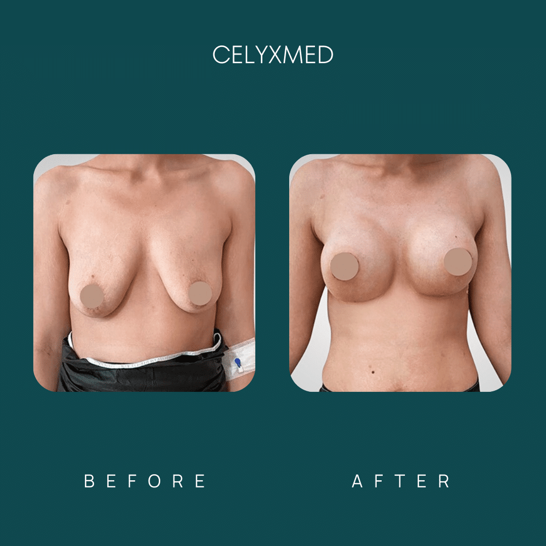 breast-augmentation-in-turkey-before-and-after-5