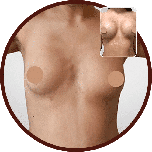 Breast Augmentation in Turkey – All Included £3,600