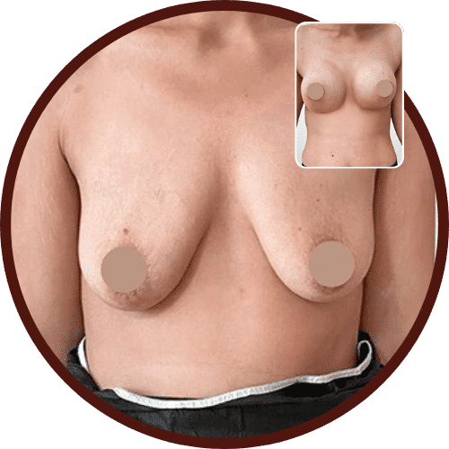 Breast Lift in Turkey – All Included £2,950