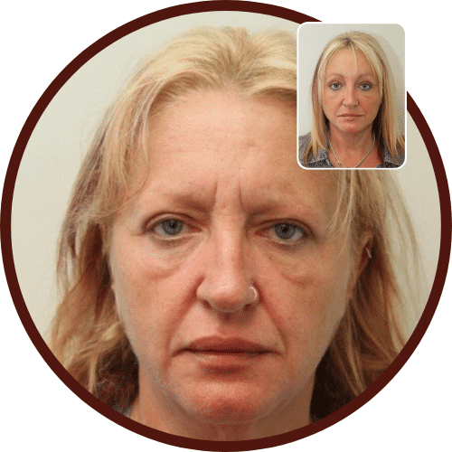 Face Lift Cost in Turkey – All Included £3,095