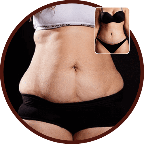 Liposuction in Turkey – All Included Starting Form £2,390