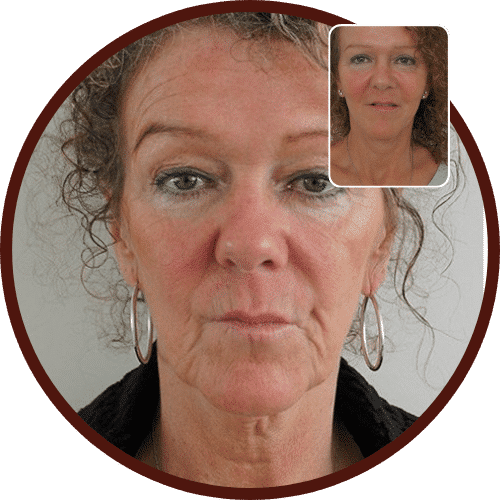 Neck Lift Cost in Turkey – All Included £2,485