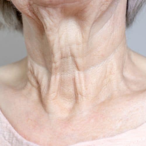 Reasons for Considering a Neck Lift