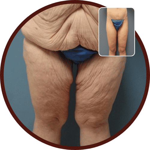 Thigh Lift in Turkey – All Included £2,950