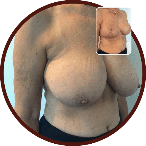 Breast Reduction in Turkey – All Included £3,000